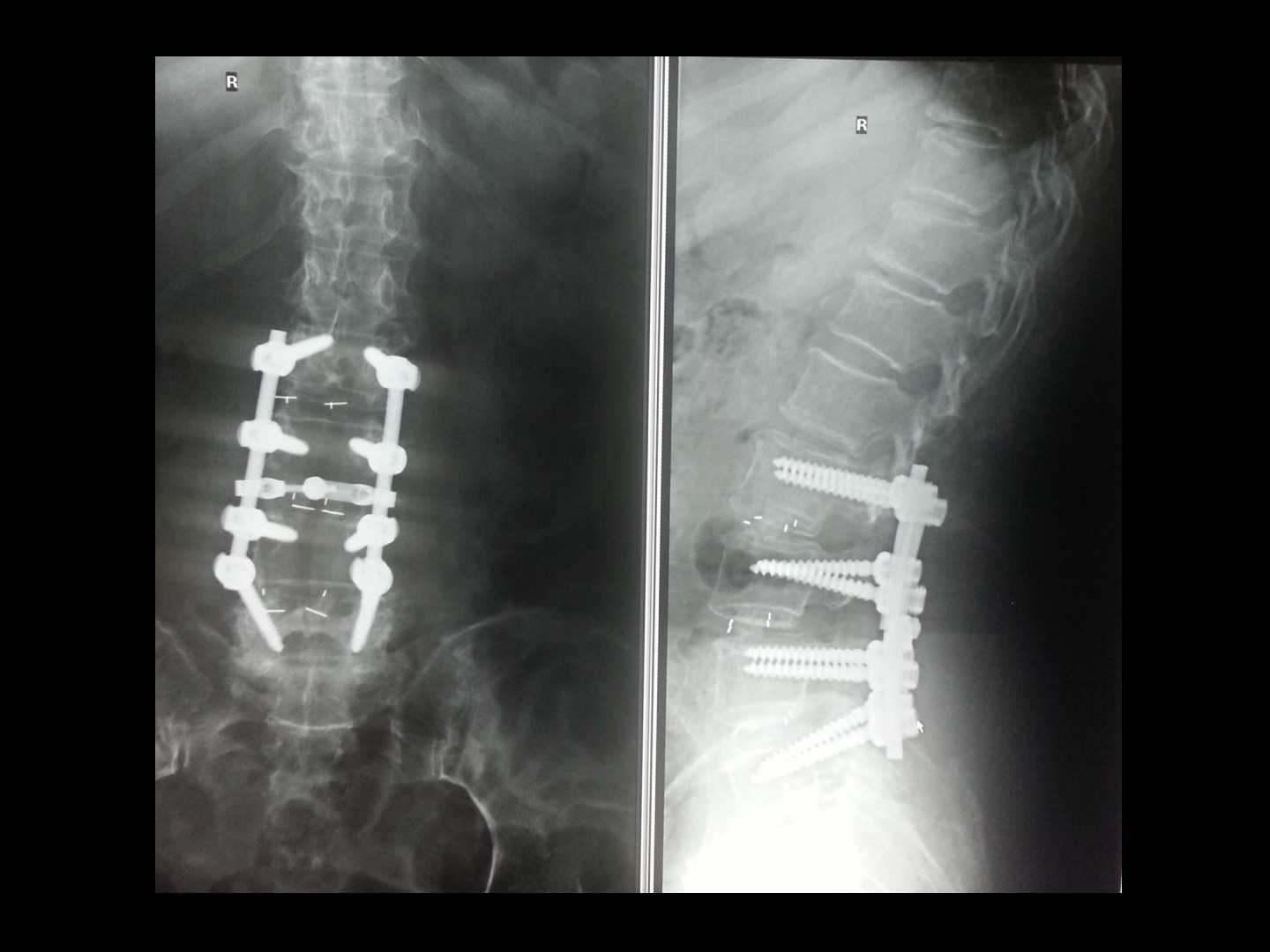 老年脊柱骨质疏松骨折的诊治