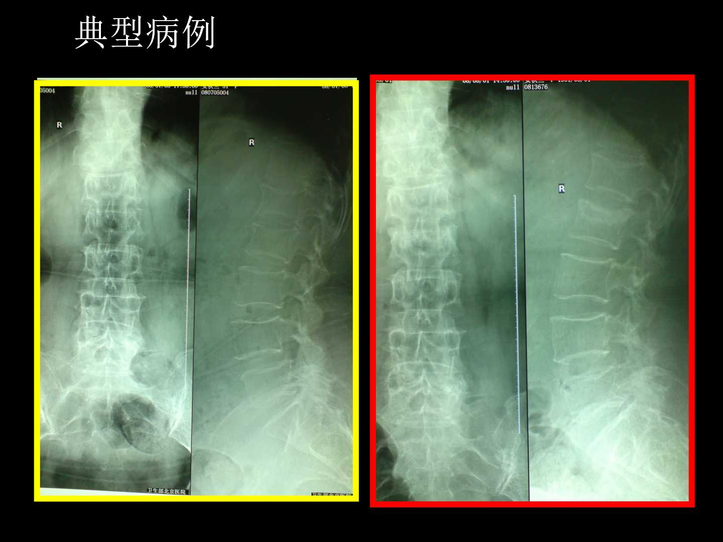 老年脊柱骨质疏松骨折的诊治