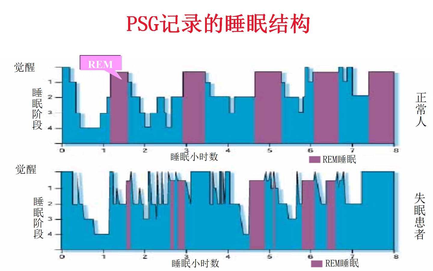 睡眠障碍与慢性疾病