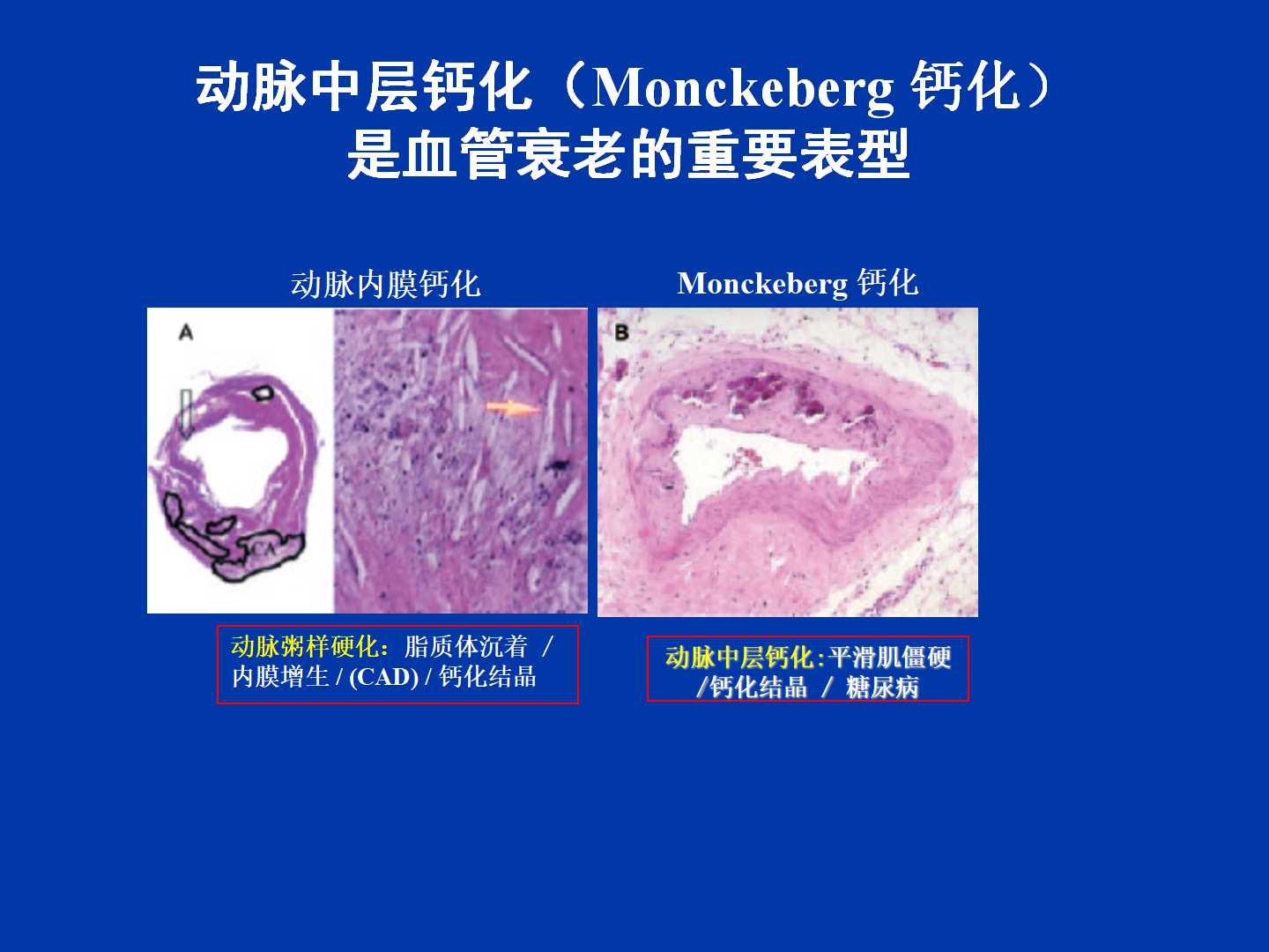 糖尿病性血管衰老