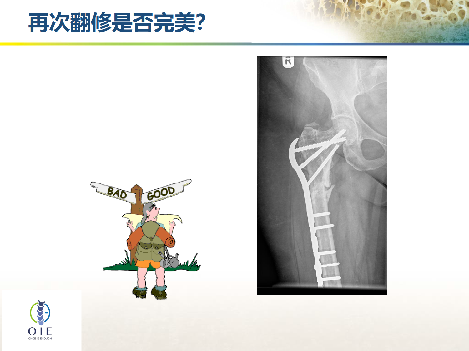 从髋部脆性骨折病例谈手术和抗骨松治疗