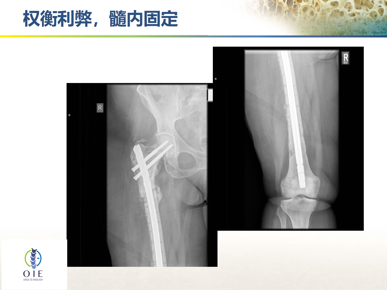 从髋部脆性骨折病例谈手术和抗骨松治疗