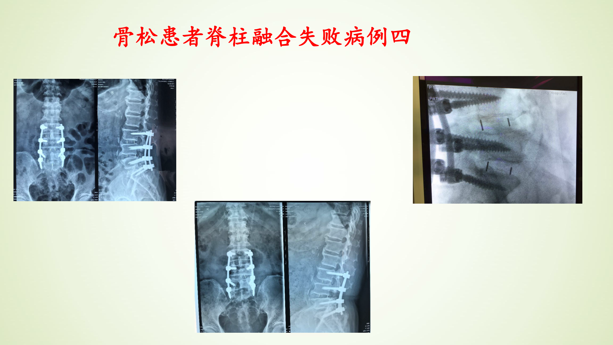 脊柱融合术如何面对老年骨松患者