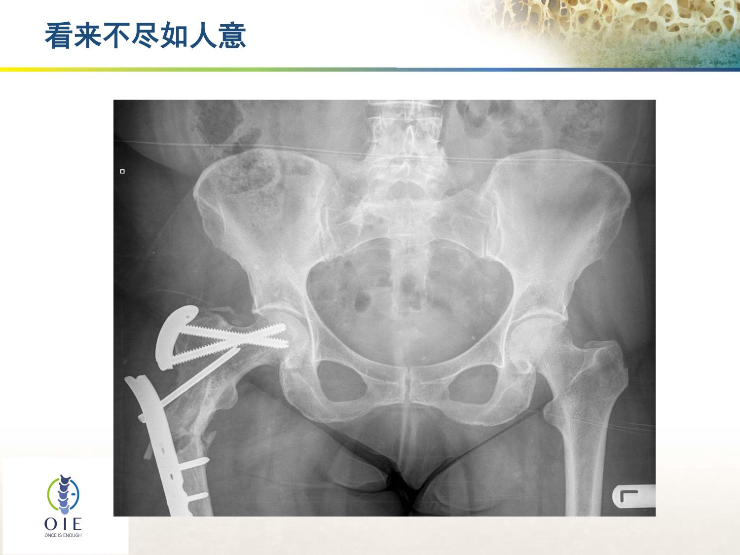 从髋部脆性骨折病例谈手术和抗骨松治疗