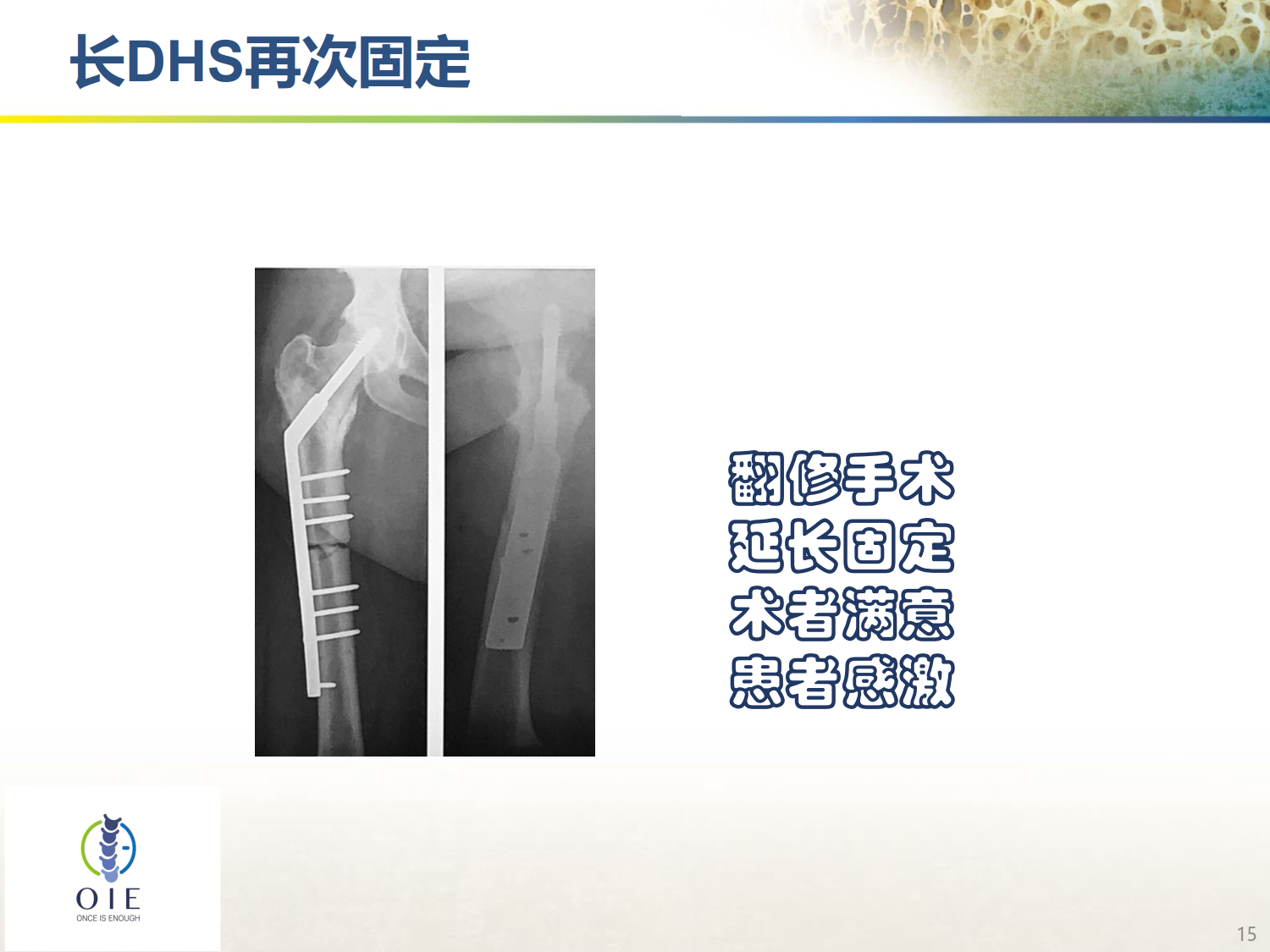 从髋部脆性骨折病例谈手术和抗骨松治疗