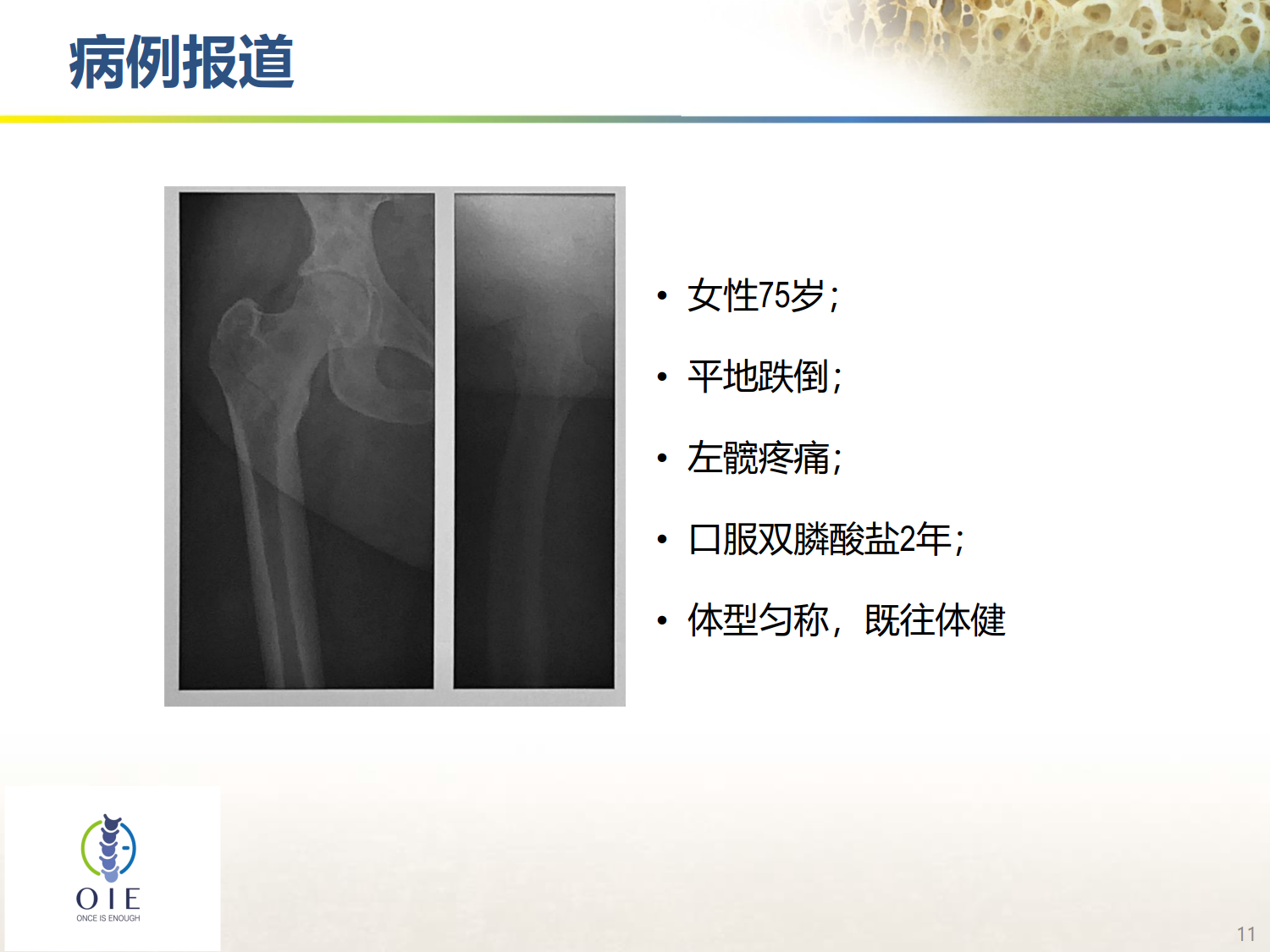 从髋部脆性骨折病例谈手术和抗骨松治疗