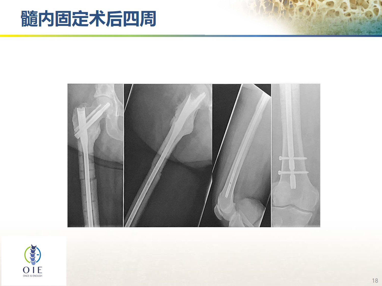 从髋部脆性骨折病例谈手术和抗骨松治疗