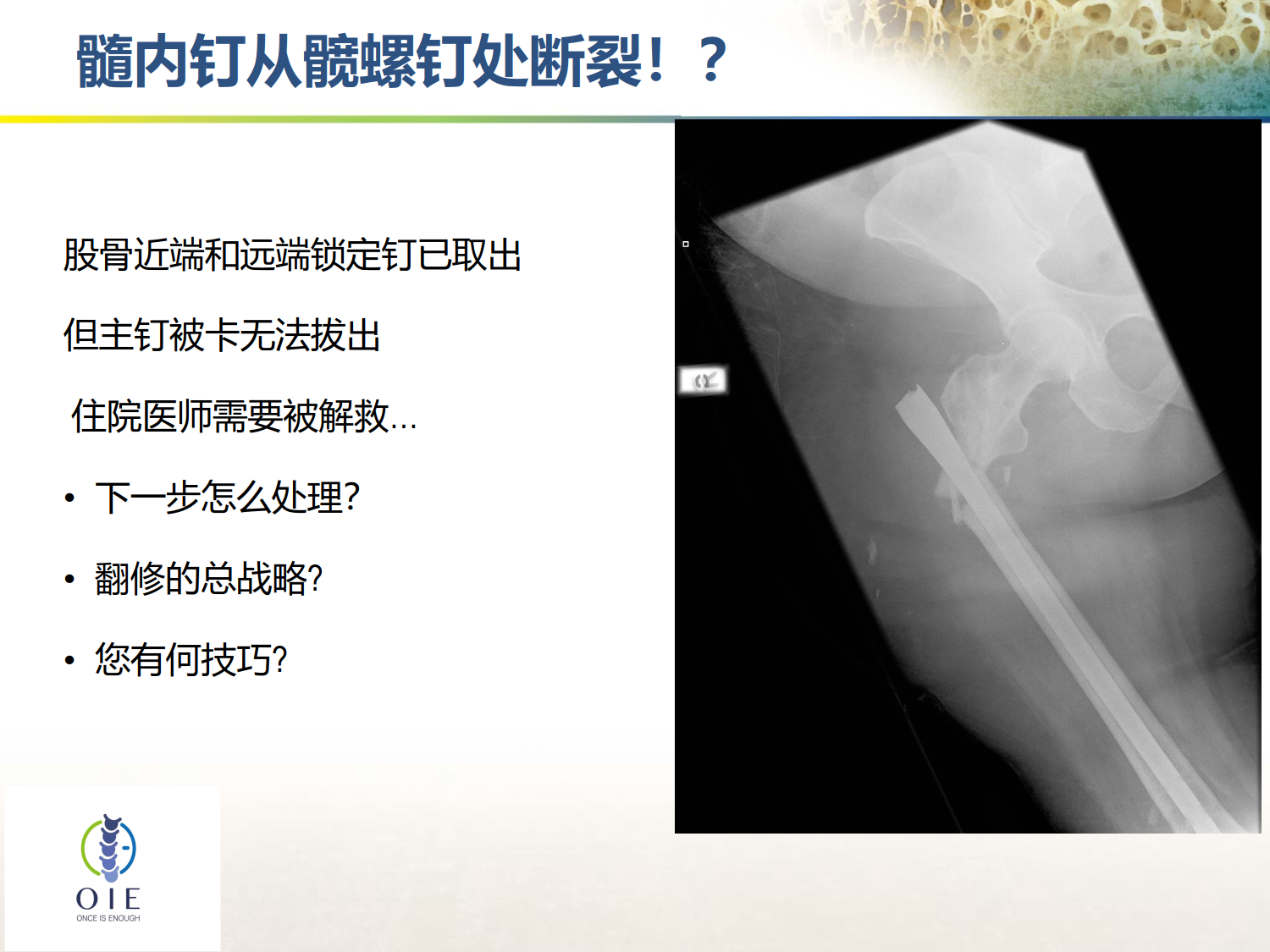 从髋部脆性骨折病例谈手术和抗骨松治疗