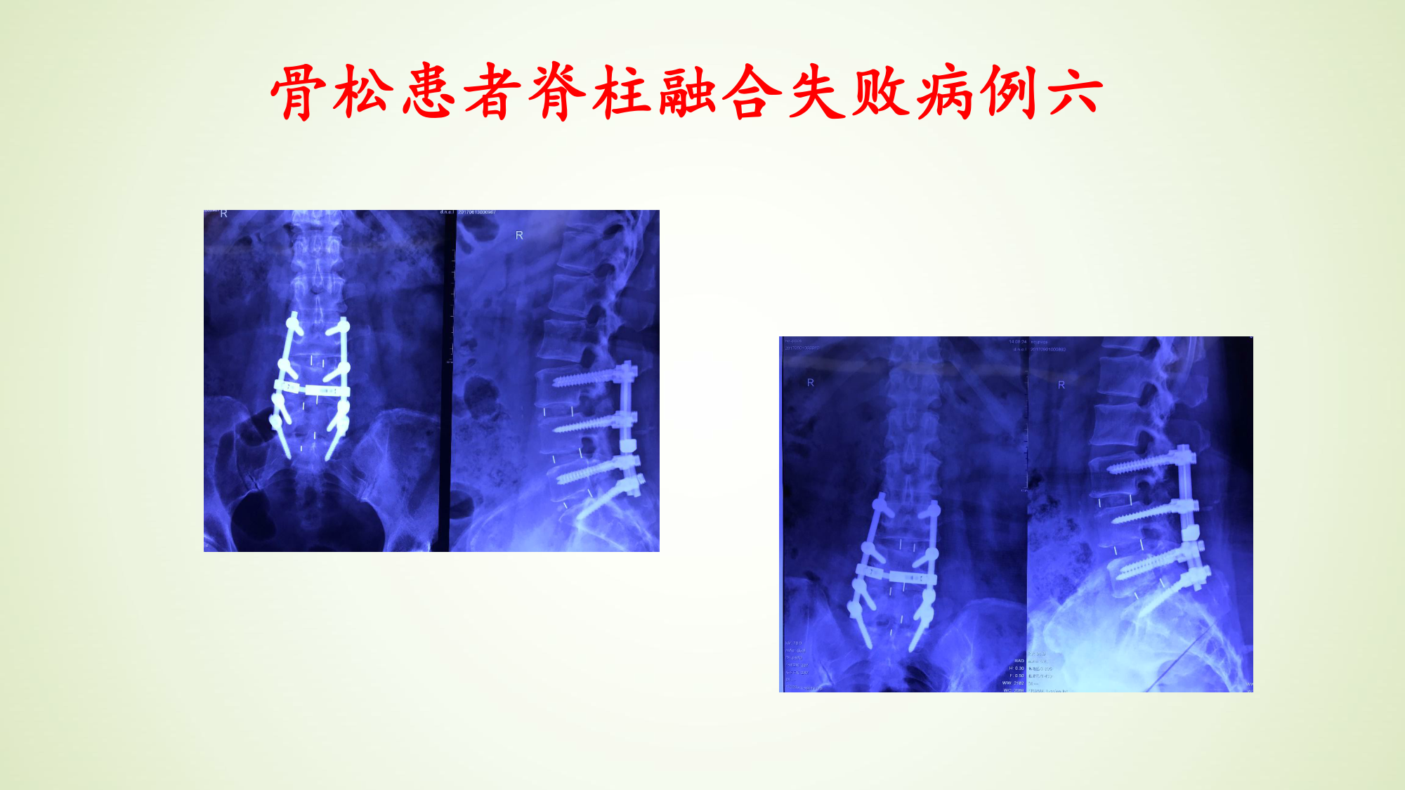 脊柱融合术如何面对老年骨松患者