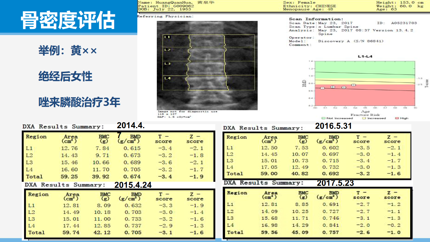 从依从性角度谈骨质疏松症的治疗