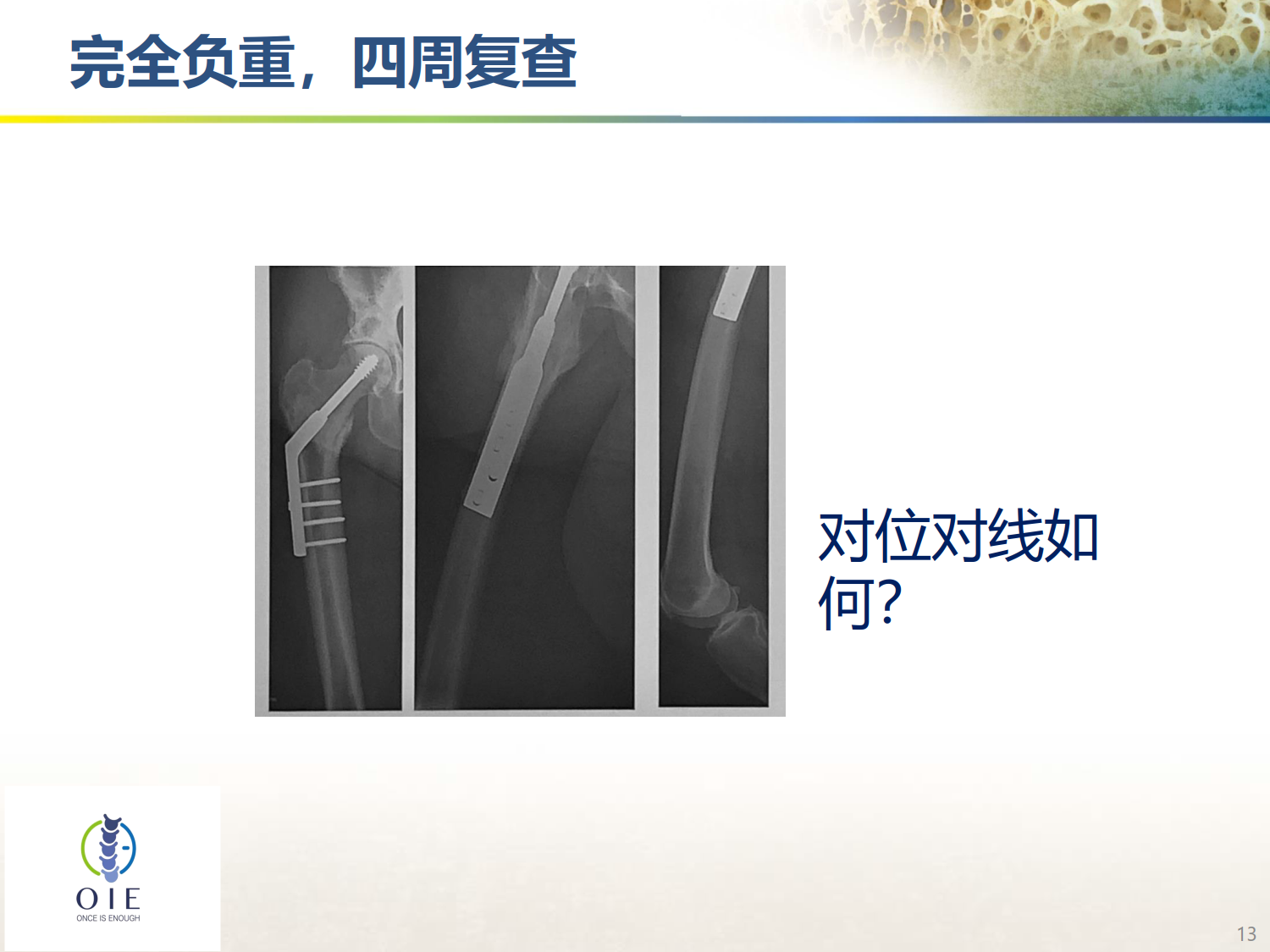 从髋部脆性骨折病例谈手术和抗骨松治疗