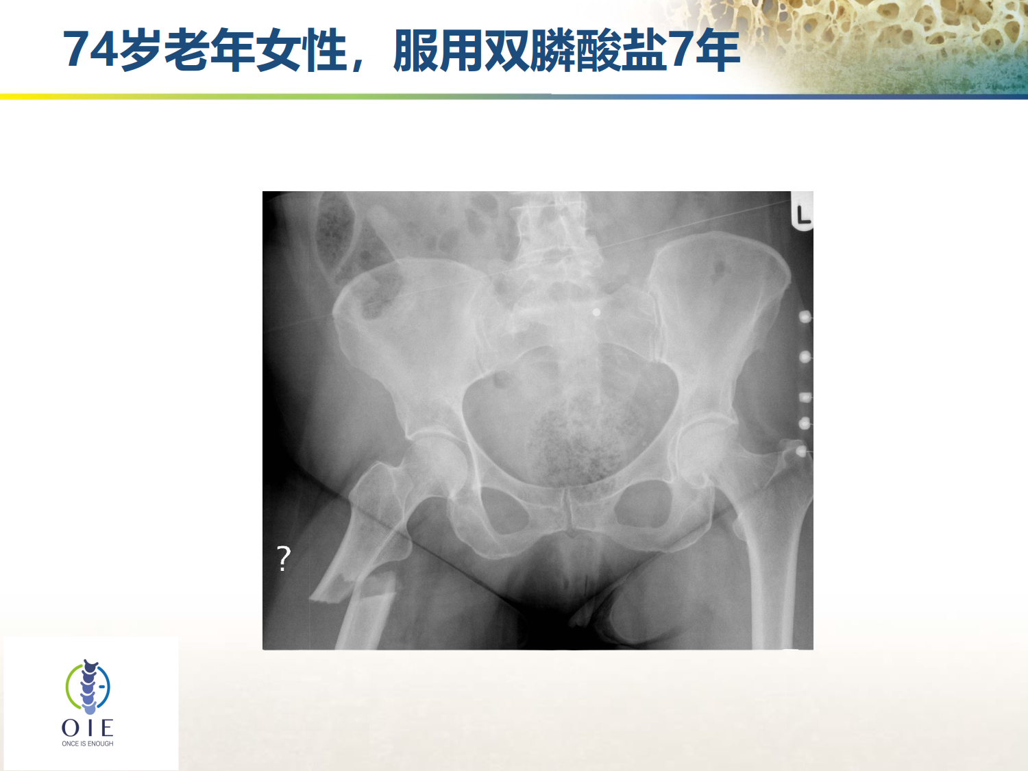 从髋部脆性骨折病例谈手术和抗骨松治疗