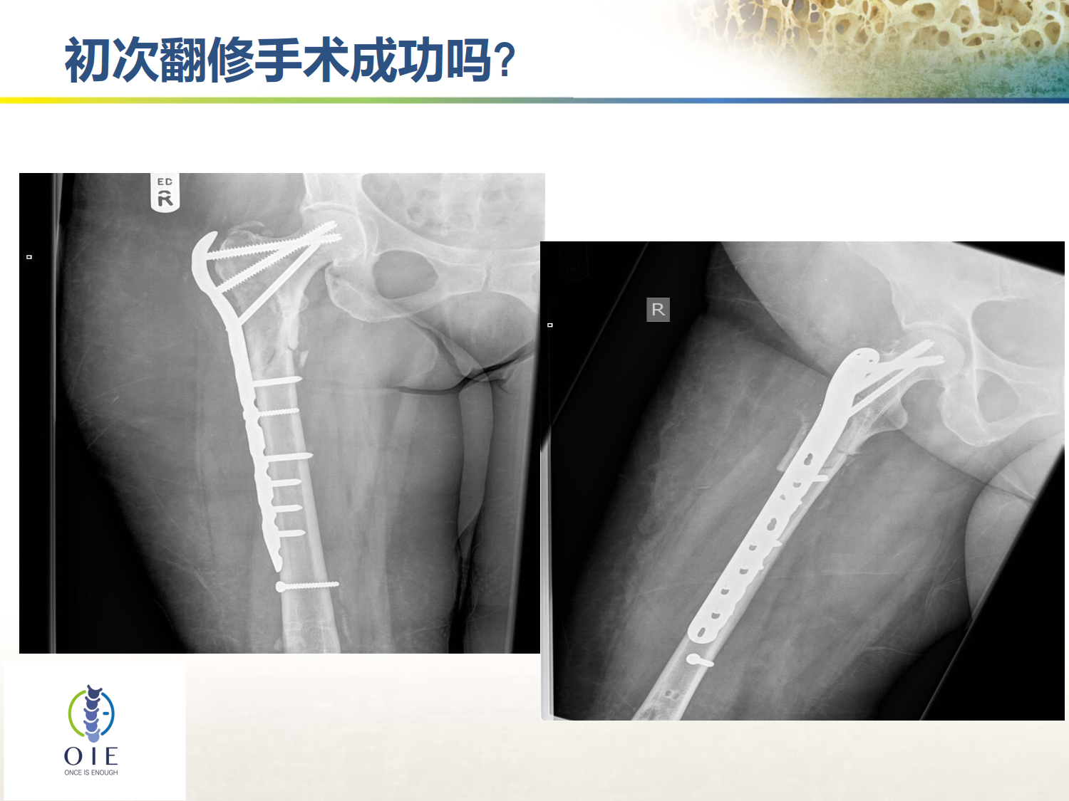 从髋部脆性骨折病例谈手术和抗骨松治疗