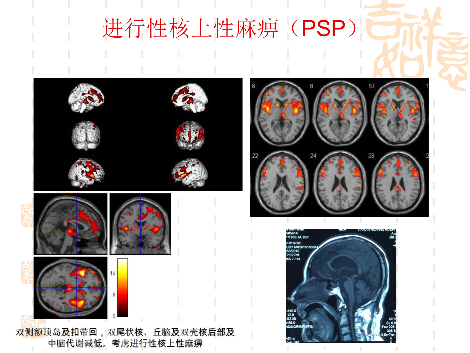 痴呆的精神行为症状诊断和治疗