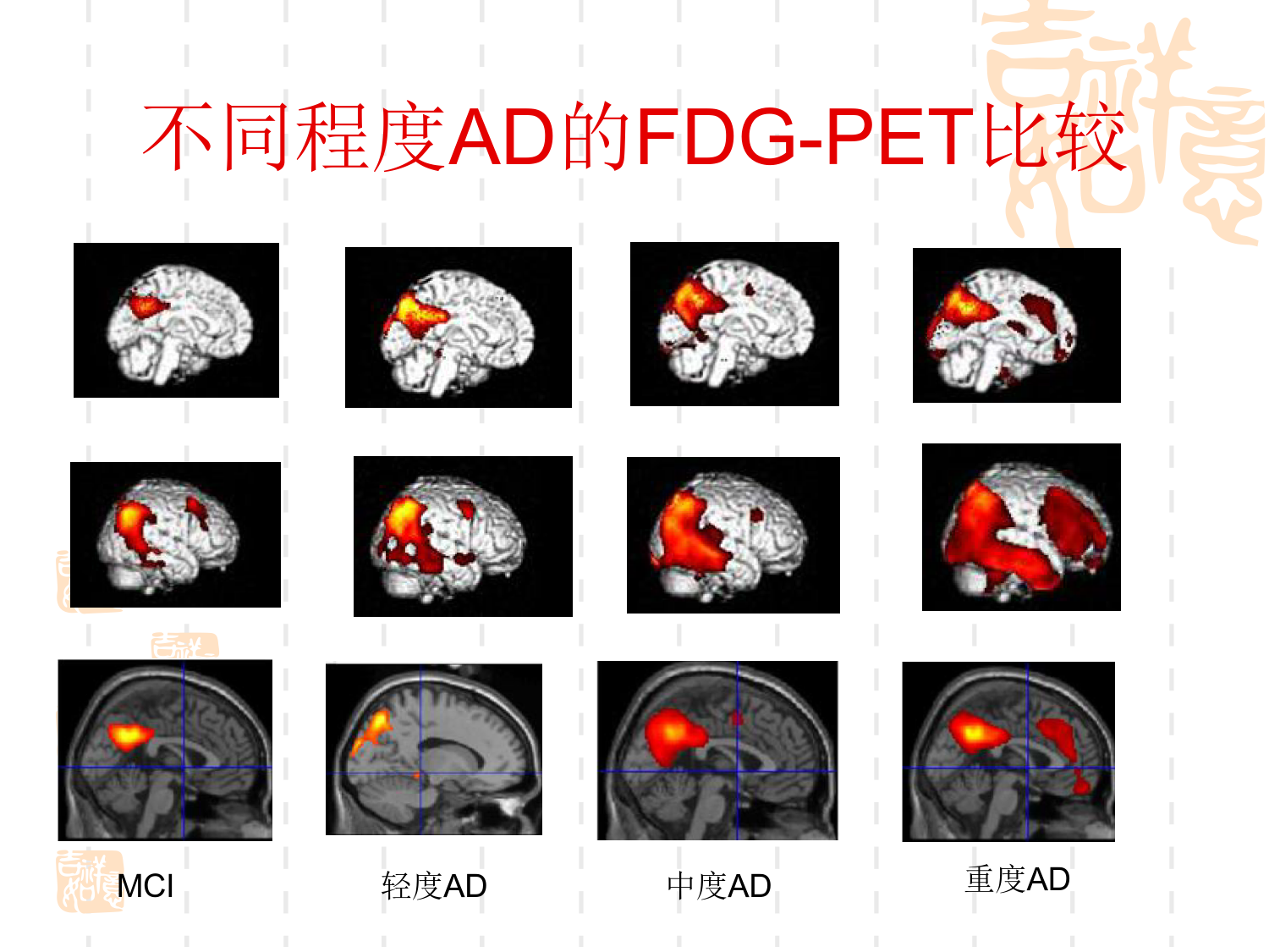 痴呆的精神行为症状诊断和治疗