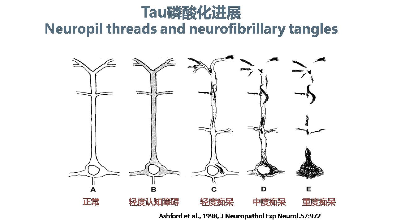 美国阿尔茨海默病研究现状与MemTrax应用