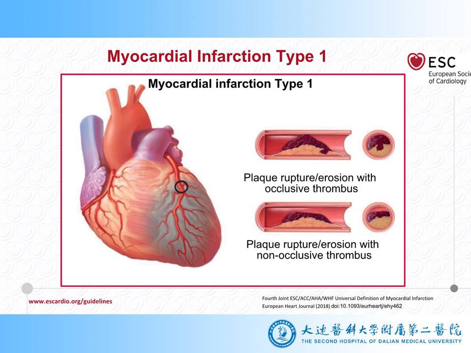 第四次全球心肌梗死定义2018解读