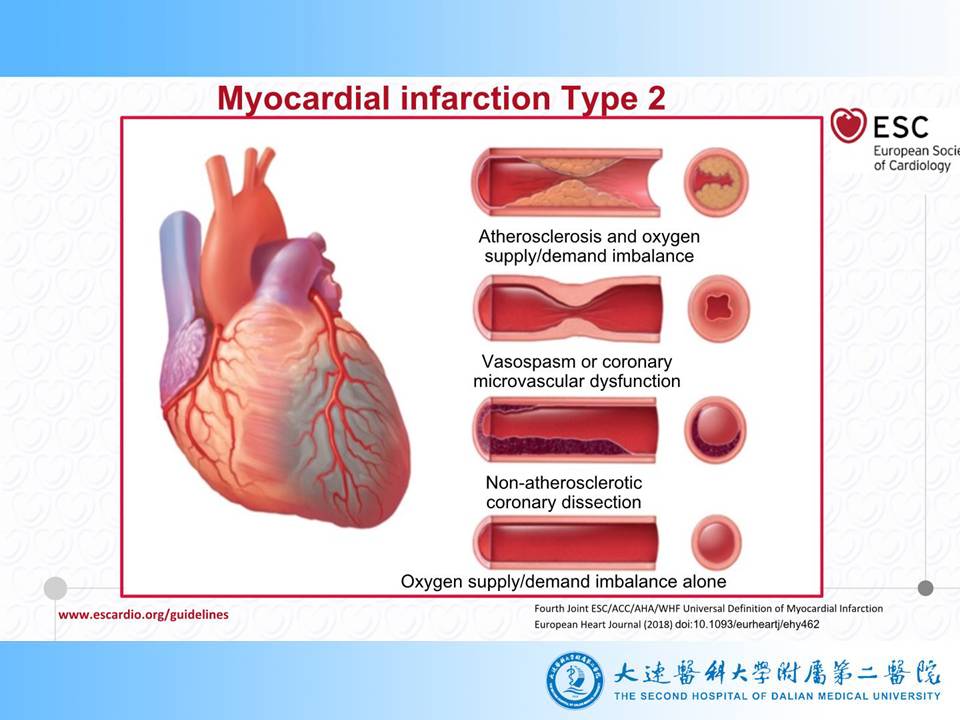 第四次全球心肌梗死定义2018解读