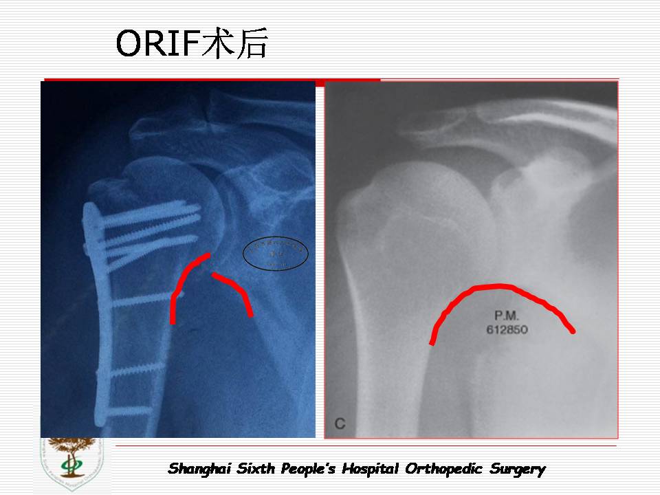 老年肱骨近端骨折治疗的挑战