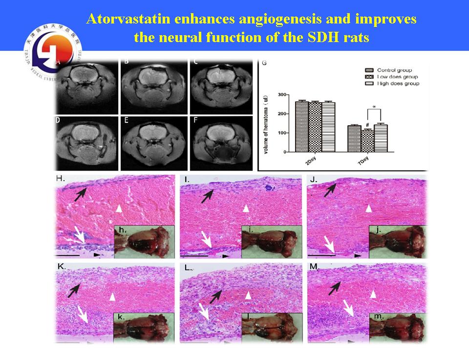 NEW Therapeutics on Chronic Subdural Hematoma