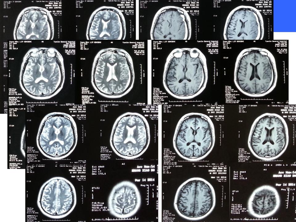 NEW Therapeutics on Chronic Subdural Hematoma