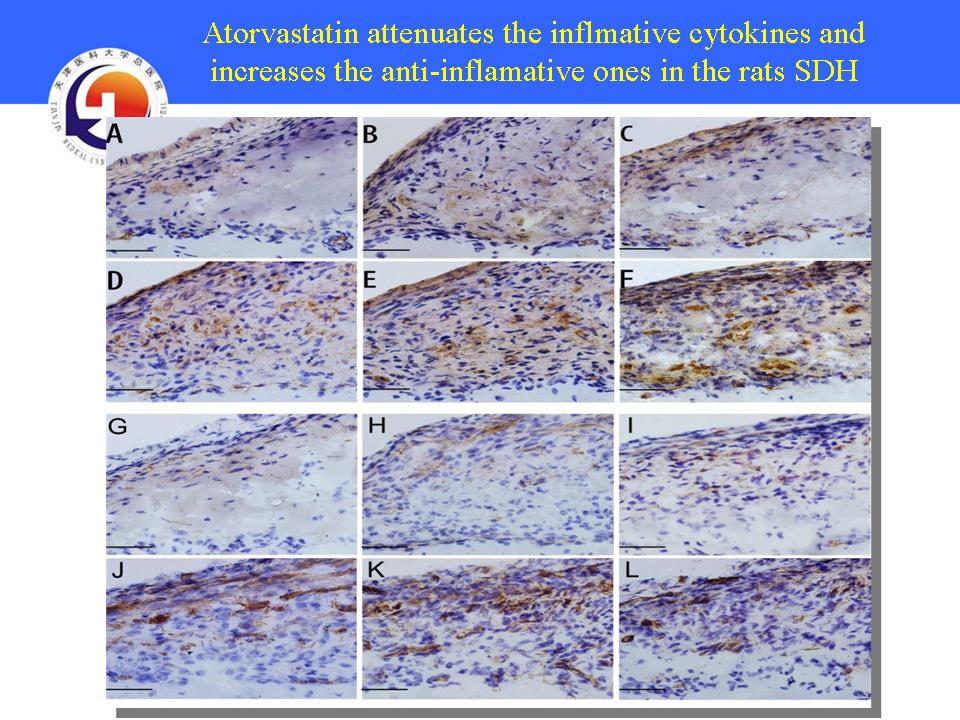 NEW Therapeutics on Chronic Subdural Hematoma