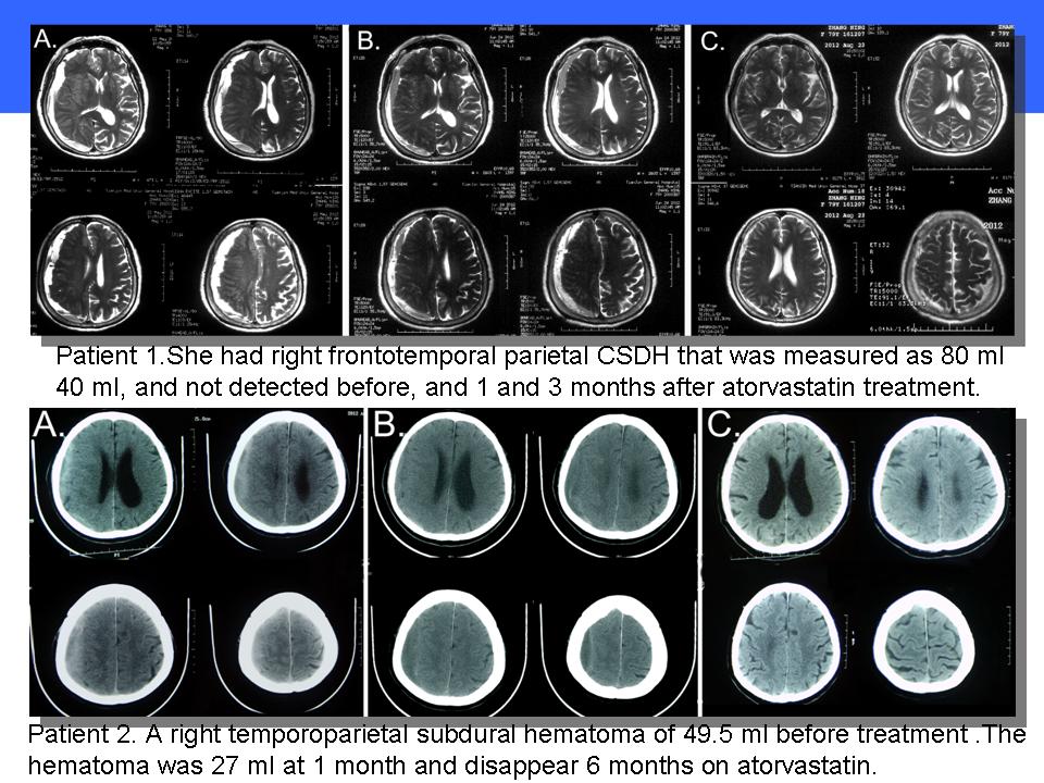 NEW Therapeutics on Chronic Subdural Hematoma