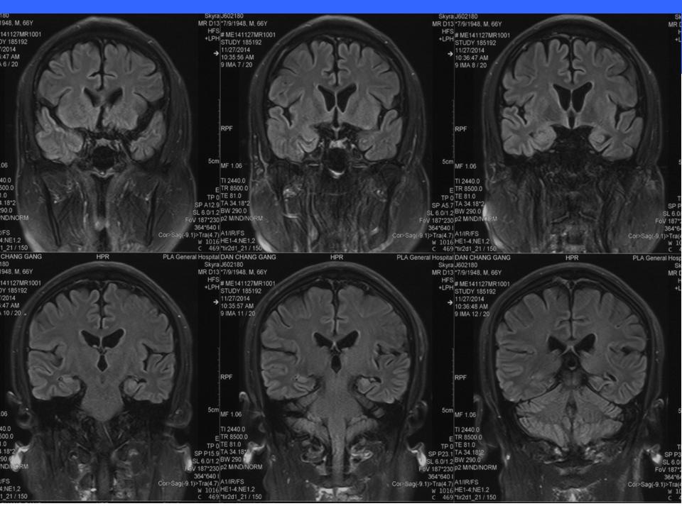 NEW Therapeutics on Chronic Subdural Hematoma