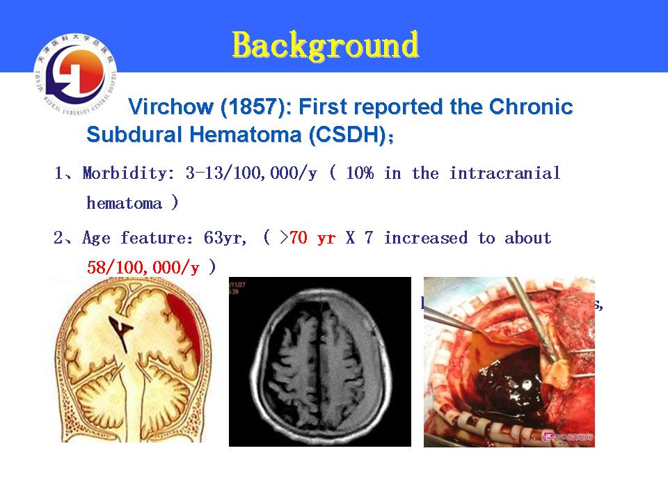 NEW Therapeutics on Chronic Subdural Hematoma