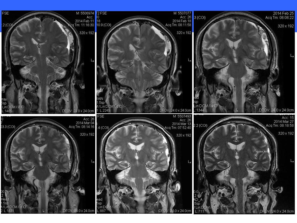 NEW Therapeutics on Chronic Subdural Hematoma