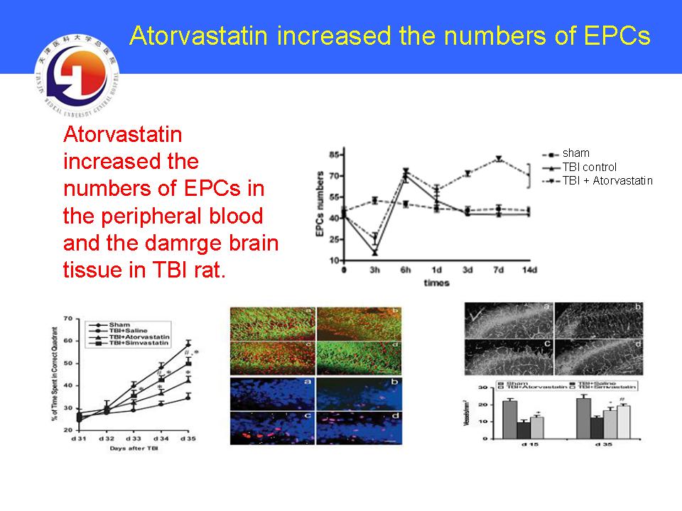 NEW Therapeutics on Chronic Subdural Hematoma