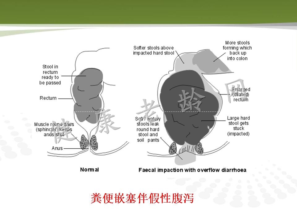 老年人消化道动力改变与临床