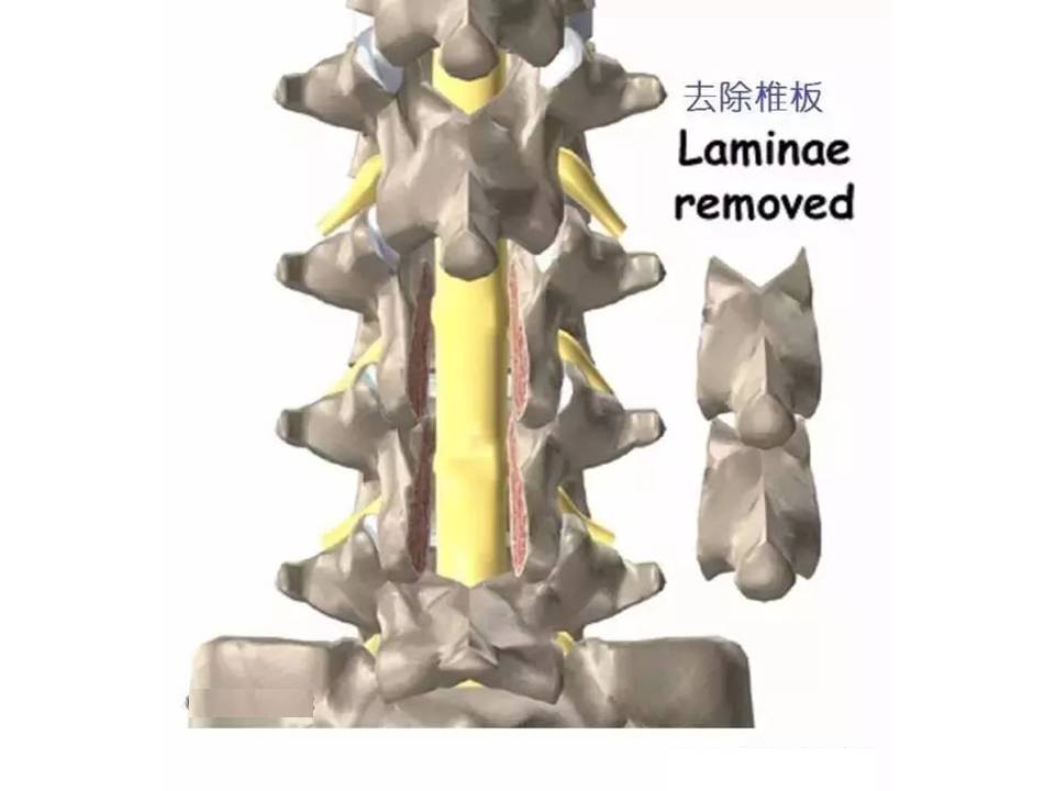 腰椎管狭窄症患者指南（二）