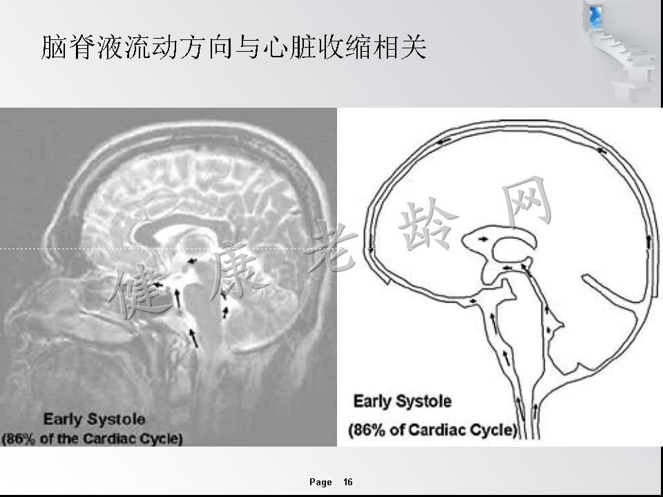 特发性正常压力脑积水—可以逆转的痴呆