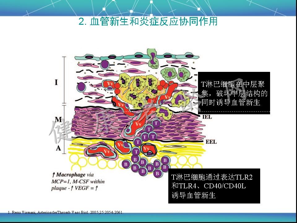 动脉粥样硬化易损斑块与干预