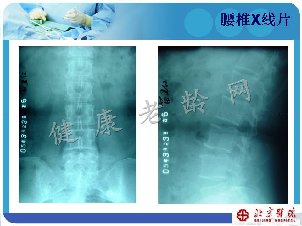 中老年骨关节炎诊治现状