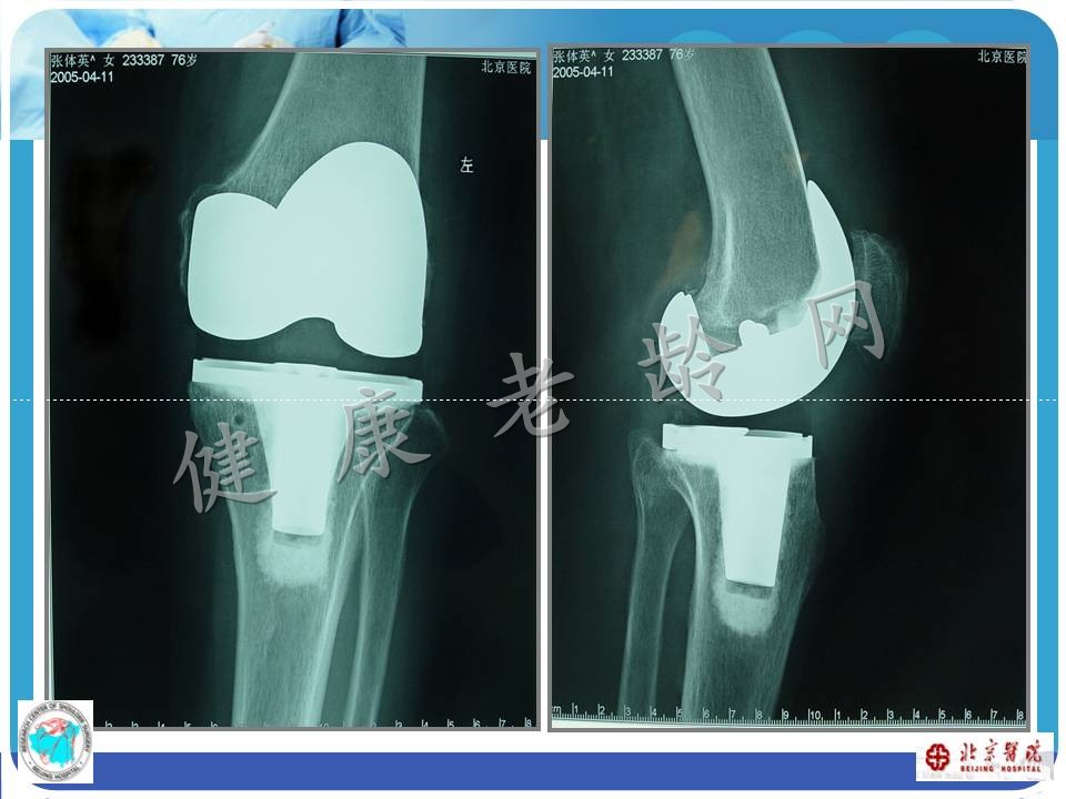 中老年骨关节炎诊治现状