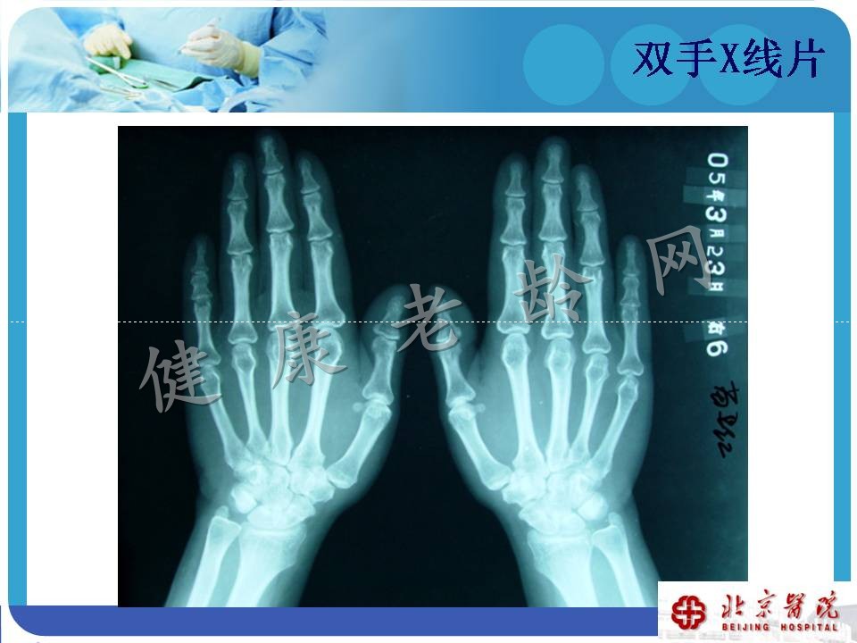 中老年骨关节炎诊治现状