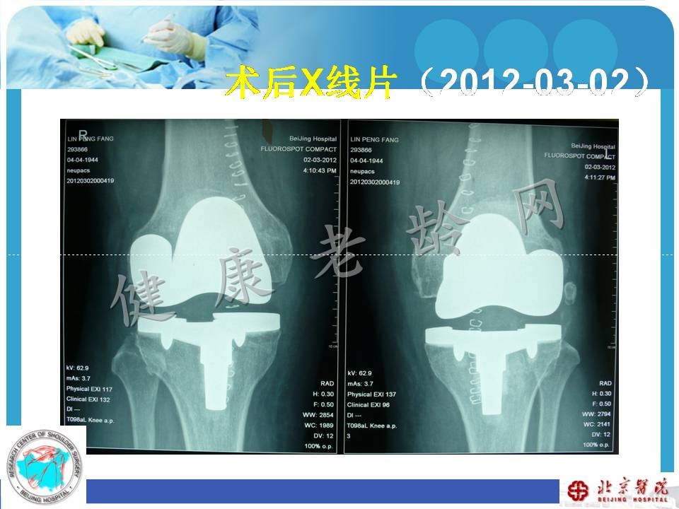 中老年骨关节炎诊治现状