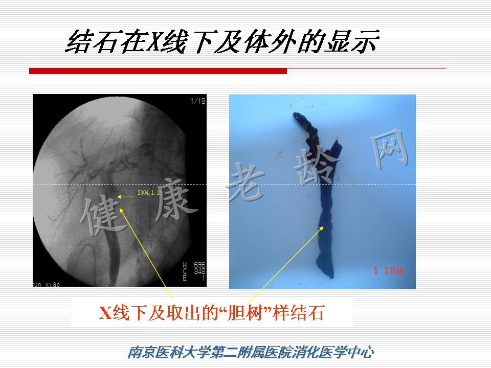 老年患者ERCP机遇与挑战