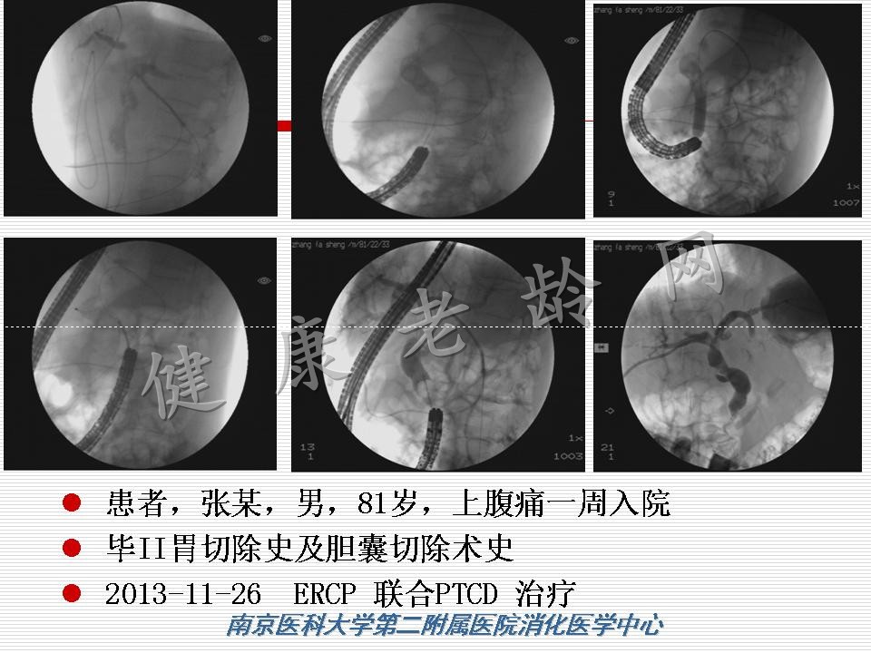 老年患者ERCP机遇与挑战