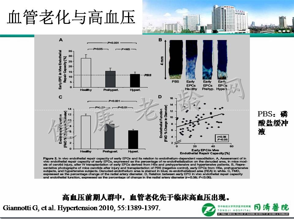 老年高血压与脉搏波传导速度