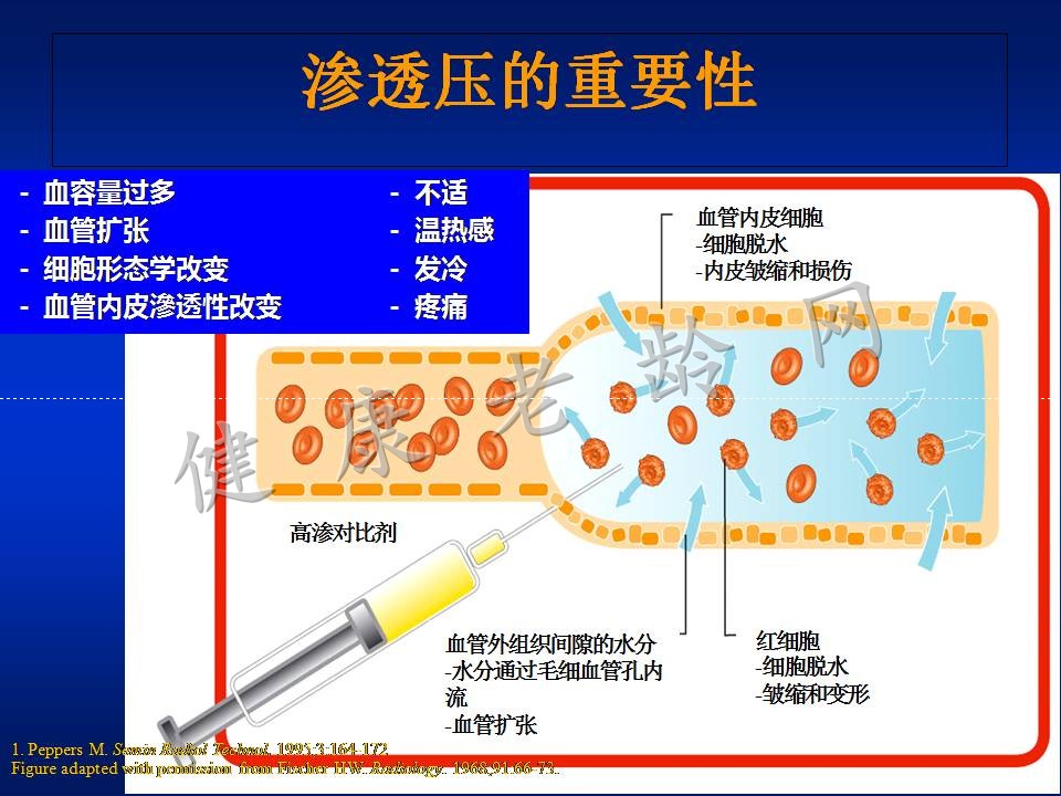 对比剂肾病