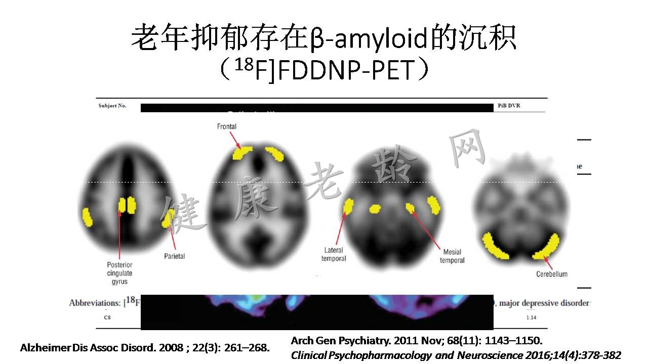 老年抑郁与认知功能障碍