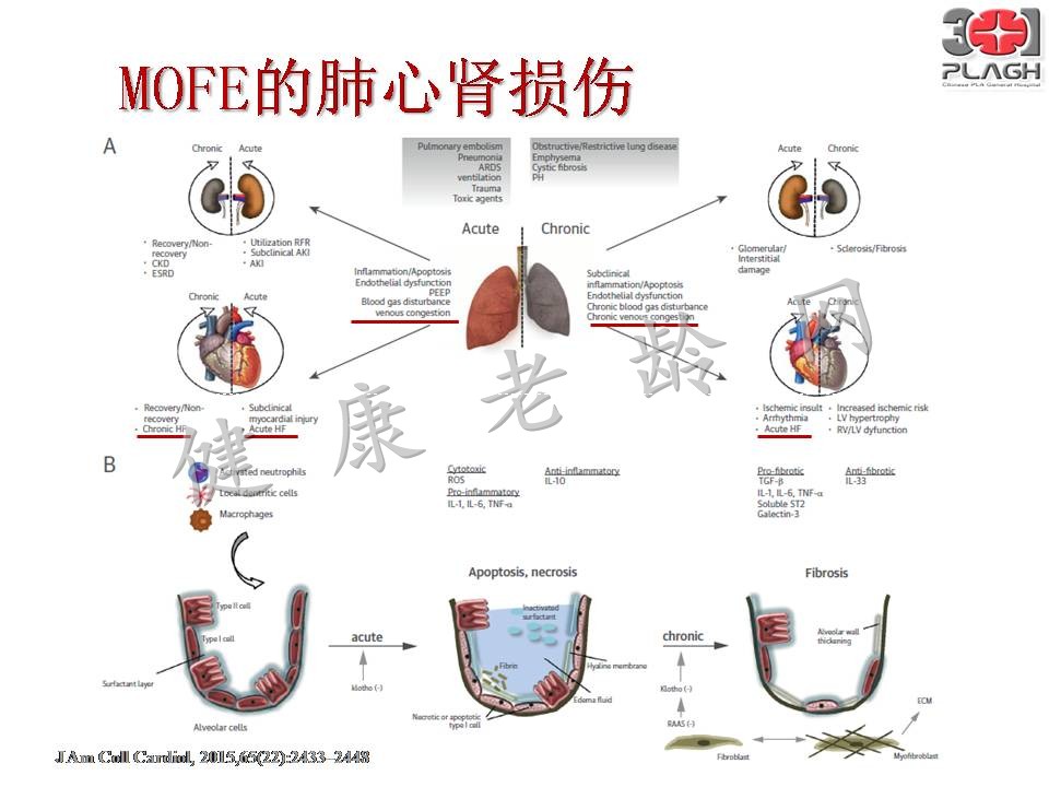 老年多器官衰竭的血液净化治疗