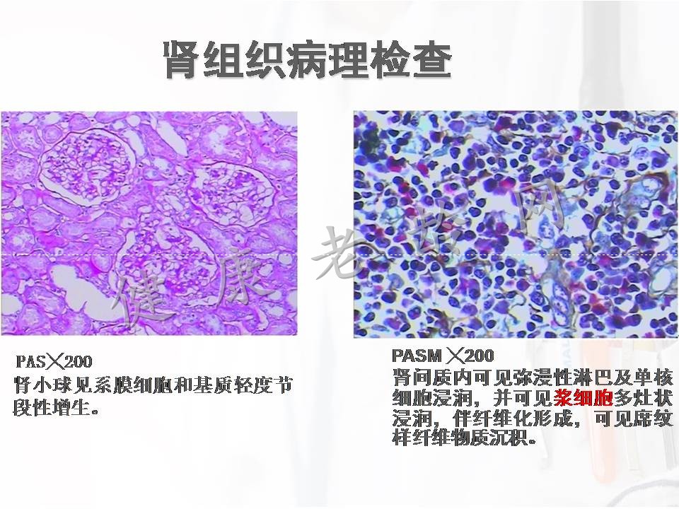 新的中老年自身免疫性疾病——lgG4相关性疾病肾损害的诊治