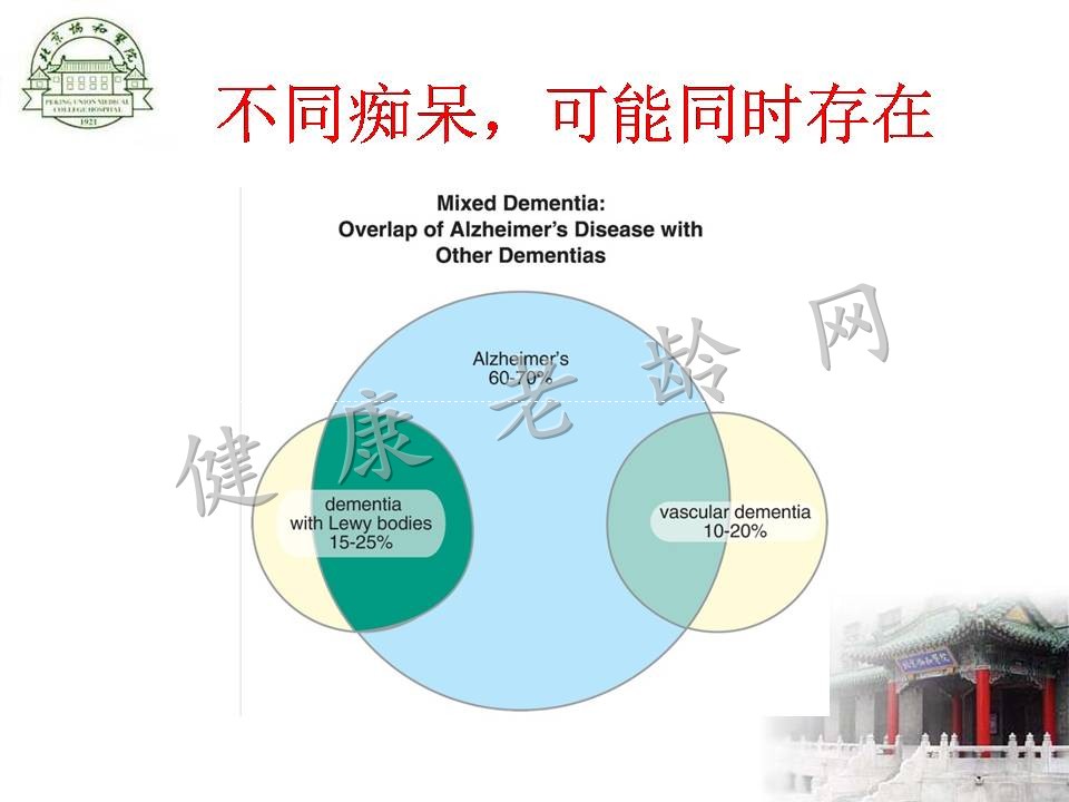 路易体痴呆的诊断和治疗