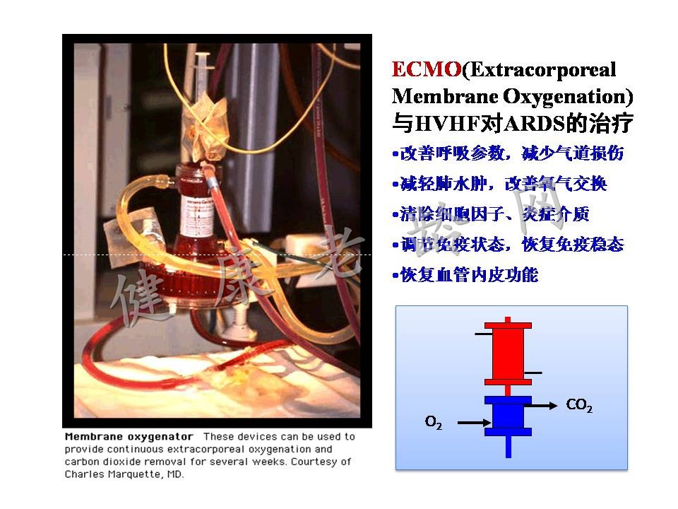 老年多器官衰竭的血液净化治疗
