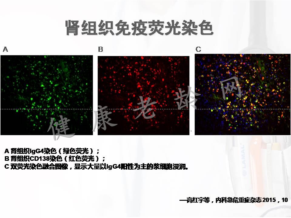 新的中老年自身免疫性疾病——lgG4相关性疾病肾损害的诊治