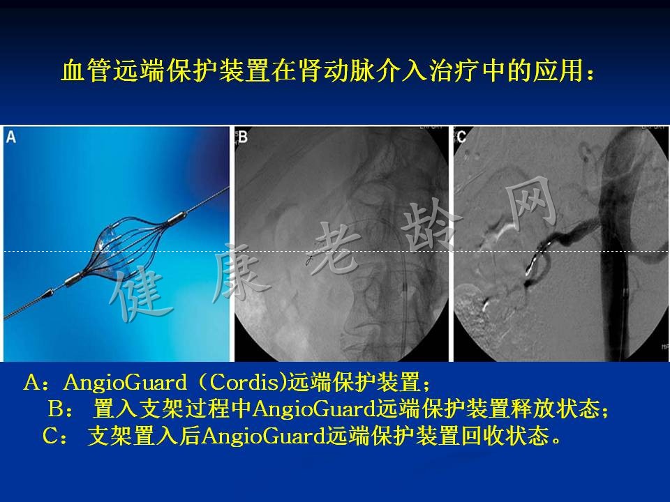 老年肾动脉狭窄介入治疗策略